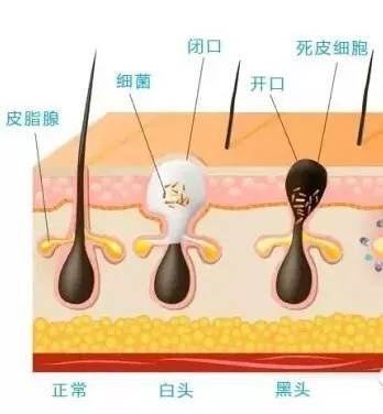 為什么右臉會長痘痘？怎么祛除？