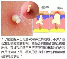 快速消除痘痘的方法