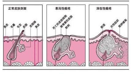 嘴角為什么長痘痘？嘴角長痘痘怎么辦？