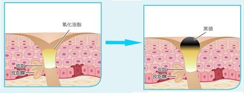 6個青春痘的治療方法