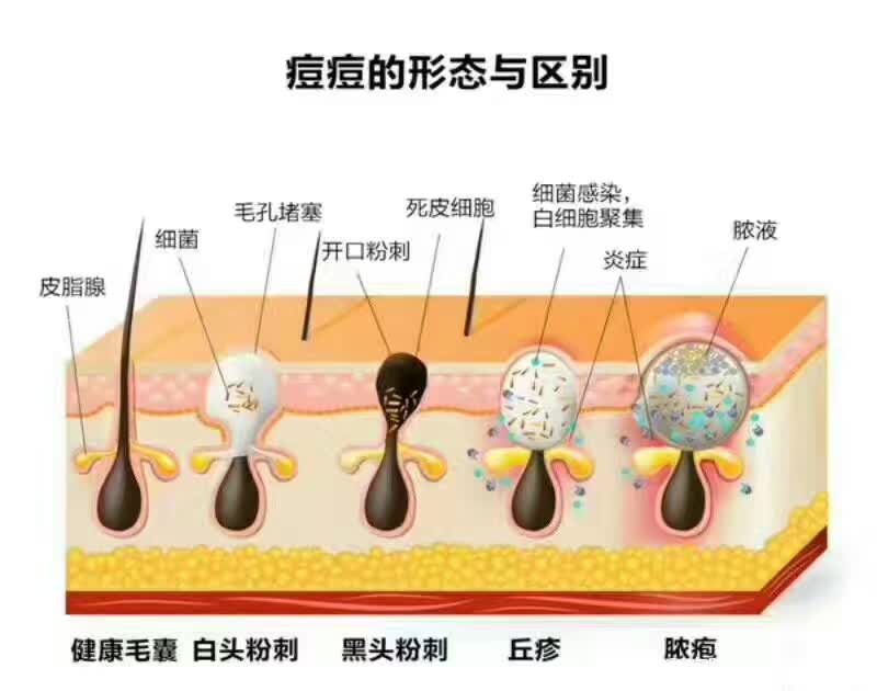 長痘的原因