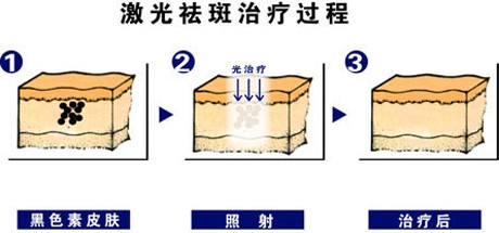 激光祛斑會反彈嗎