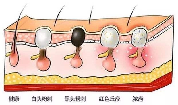 怎樣去除黑頭粉刺