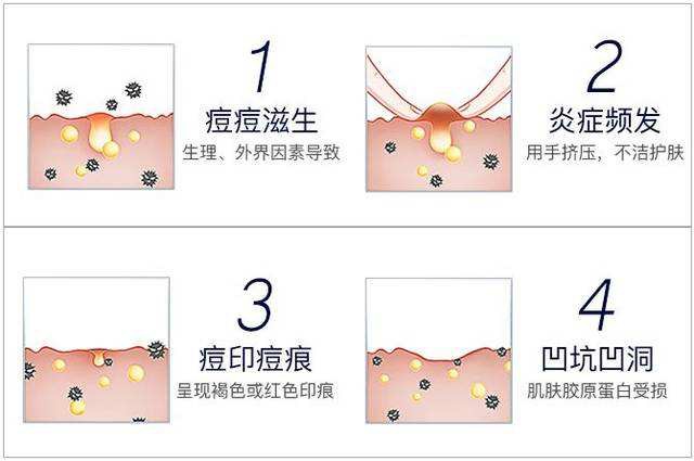 痘印和痘坑的區別