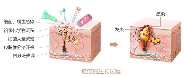 青春痘治療有哪些好方法