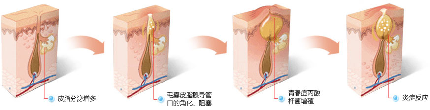 青春痘的起因