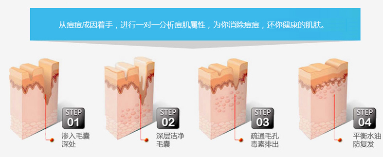 祛痘的過程