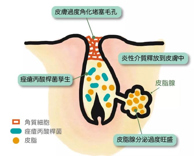 青春痘的治療方法