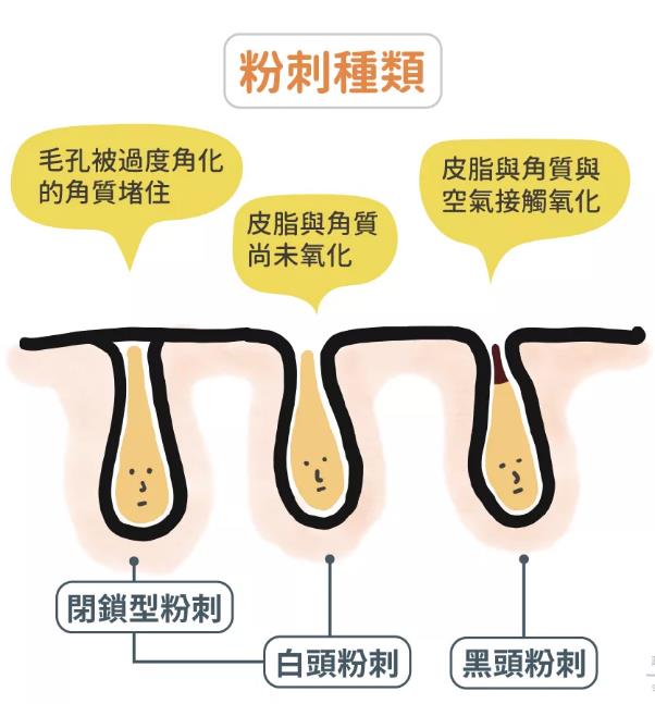 青春痘的種類