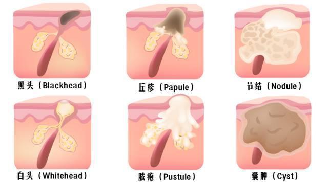 痤瘡的種類